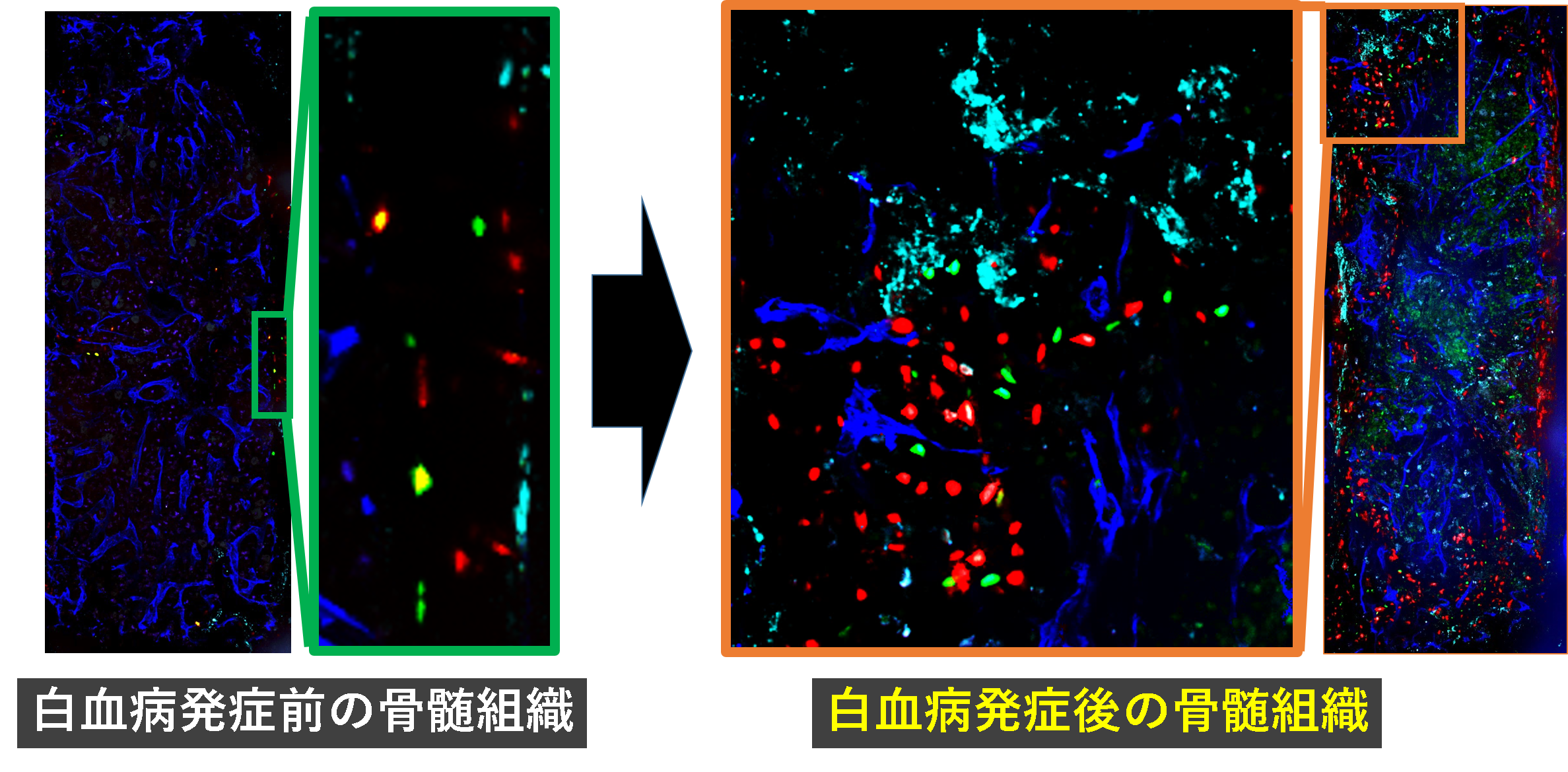 急性骨髄性白血病 (AML) と白血病幹細胞 (LSC)